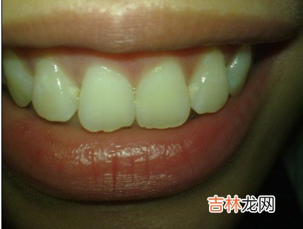 牙膏只能解决轻度牙齿有色情况 个别情况需就诊