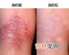 肌肤突发状况 教你8个超管用急救秘方