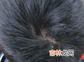 干燥秋季 6招防止头屑横行