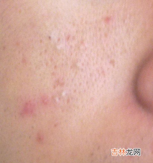 脸上长脂肪粒怎么办