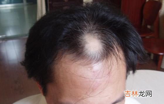 減肥不吃主食會讓你有脫發