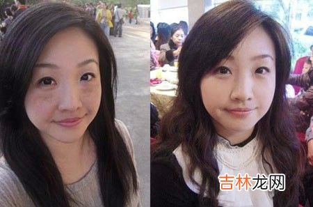 治疗斑斑的新花招