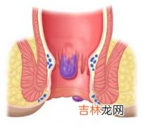 痔疮来痛难忍饮食运动要注意