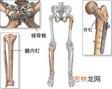 女性多走路可防髋骨骨折