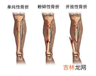 女性多走路可以减少髋骨骨折的危险