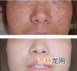 教你简单去黑色素与小斑点