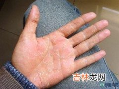 出现鼻子易脱皮怎么解决