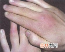 摆脱冻疮拒绝萝卜手