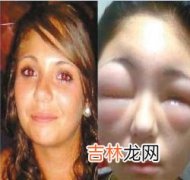 大S如此脸肿脸部消肿法慎防少女变大妈