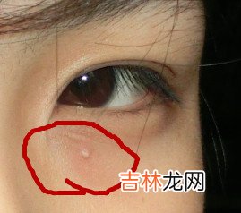 眼部的脂肪粒如何彻底清除
