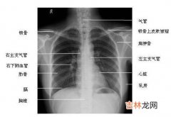 一新研究表明乳房X线照片还能发现心脏病人