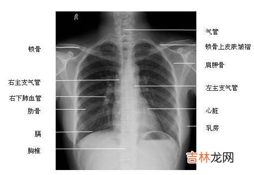 一新研究表明乳房X线照片还能发现心脏病人