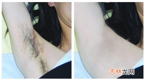 盘点给腋下脱毛的注意事项