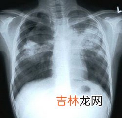 美将大规模研究数码乳房X射线造影术的优点