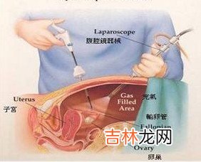 多囊卵巢综合征女性美丽的杀手