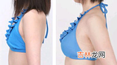 乳房良性肿瘤