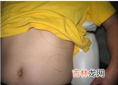 胆结石为何偏爱女性