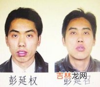 1 男人整容十五条必看问答