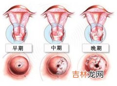 重视宫颈炎预防宫颈癌