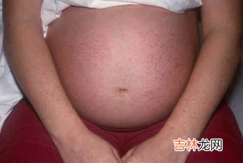 孕妇谨防皮肤病
