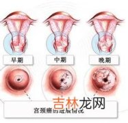 年轻女性需防宫颈癌