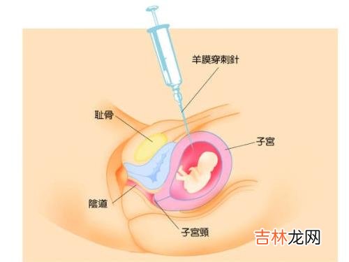 羊膜穿刺术 发育正常的胎儿
