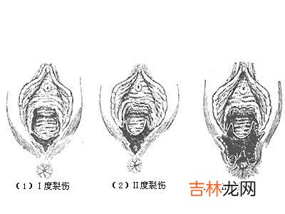 分娩时产道裂伤的表现