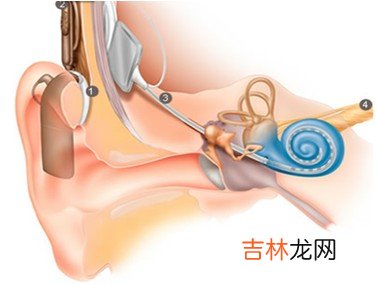 人工耳蜗手术直击