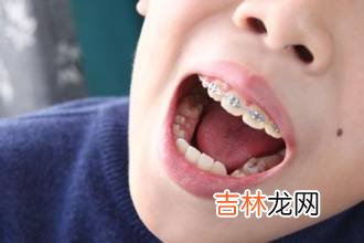 美白牙齿要恰当选择疗法