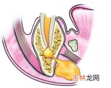 牙髓炎和根尖周炎最好的治疗方法