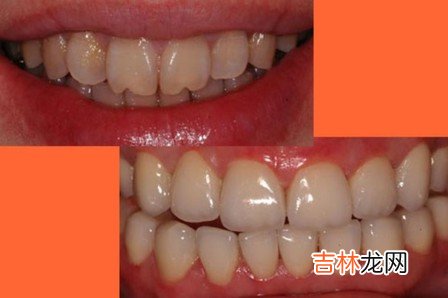 刷牙太用力牙齒受傷害