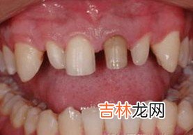 奇形怪状牙齿的形成原因