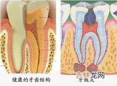 什么是牙髓摘除术