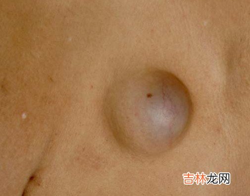 发现耳廓假性囊肿后应怎么办