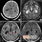 耳源性脑膜炎的治疗应怎样进行