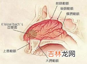 鼻骨骨折的处理方法有哪些