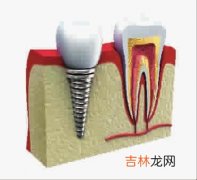 种植牙和骨能长在一起吗