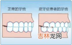 磨牙症是什么原因引起的