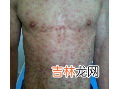 先天性梅毒三例