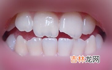 怎樣能使補的牙更牢固
