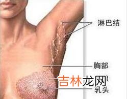 乳房Paget病肿瘤组织中Bcl2Bax雌激素和孕激素受体表达的研究