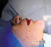 结膜下球后注射方法及注意事项是什么