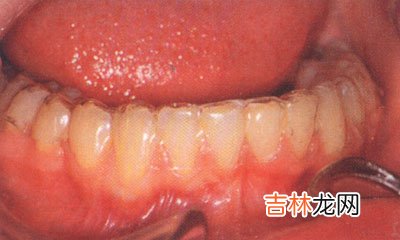 功能性矯治器的適用範圍是什麽
