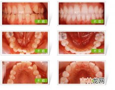 用活动矫治器可矫治哪些错牙合畸形