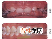 矫治力对牙牙合起什么作用