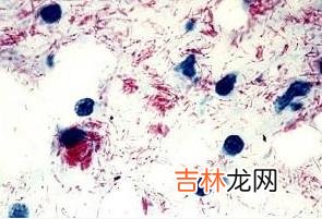 中国部分地区麻风菌的基因分型初探