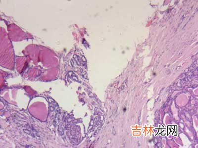 急性声嘶的病因病理是什么