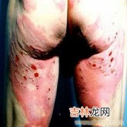 天疱疮抗体结合靶抗原的定位研究