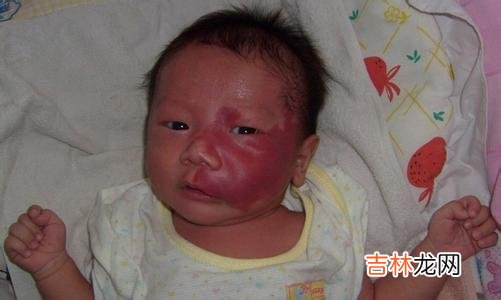 钕铁硼永磁体贴敷治疗血管瘤64例