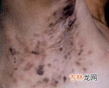 双黄连粉针剂治疗男性非淋菌性尿道炎33例